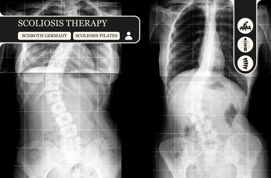 scoliosis-therapy schroth penang